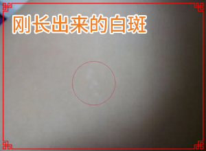 「熱門(mén)關(guān)注」手上皮膚出現白色斑點(diǎn)是什么原因？皮膚長(cháng)白斑的原因