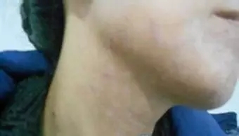 白斑治療需要多少錢(qián)
