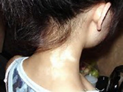 白癜風(fēng)發(fā)病后與什么癥狀相似