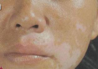 女性白癜風(fēng)的發(fā)病原因有哪些