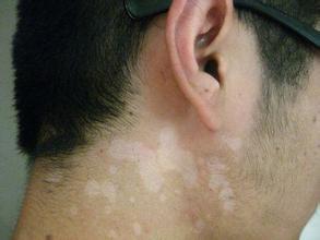 男性得了白癜風(fēng)吃什么好